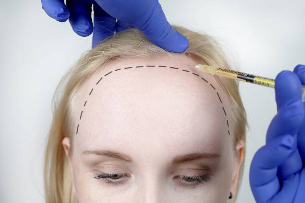 women-hair-transplant